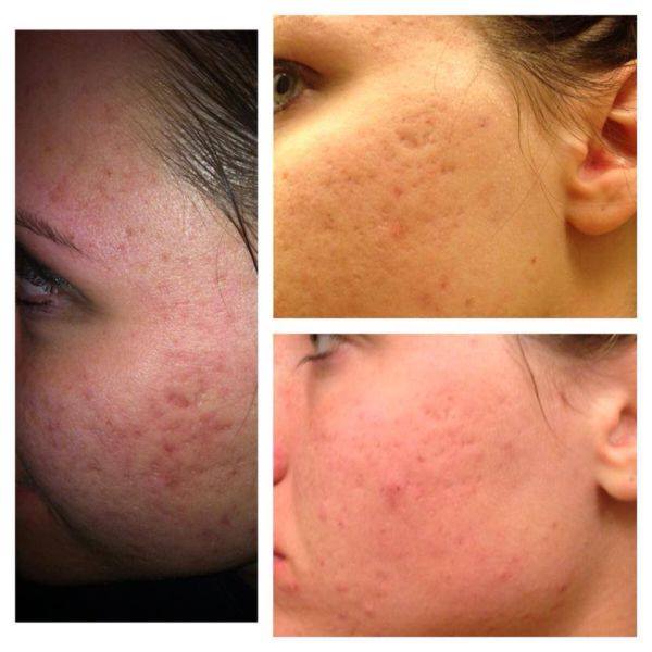 Before and After Skin Care Photos Show Proven Results