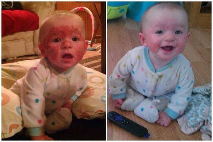 Baby Eczema