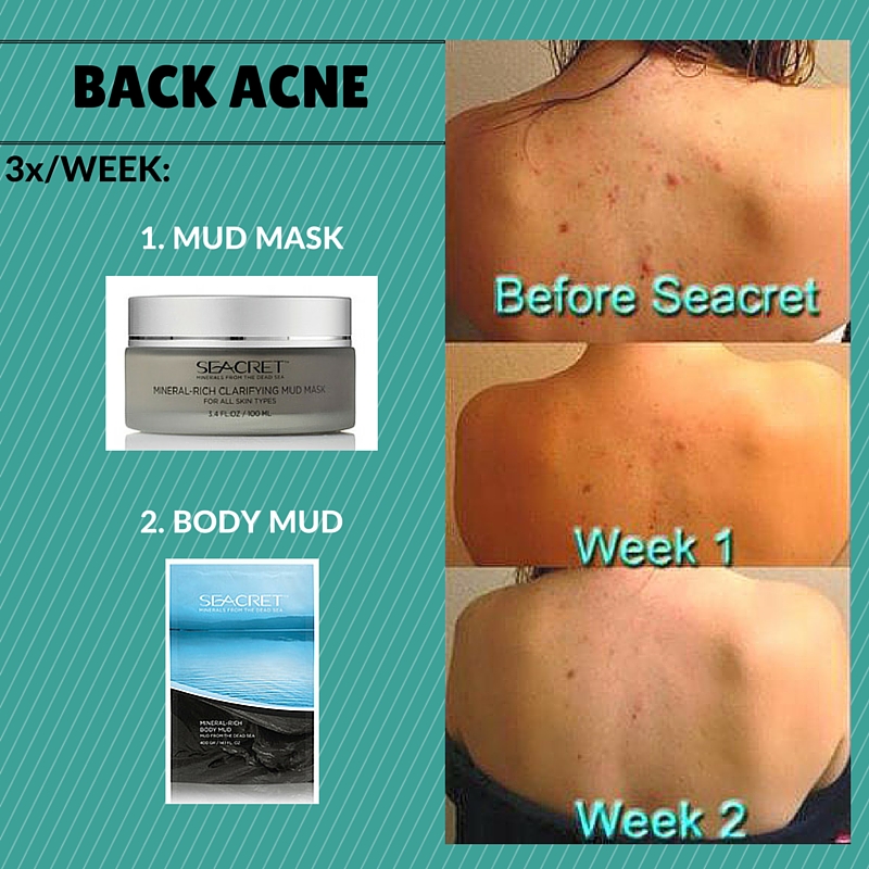 Back Acne Regimen