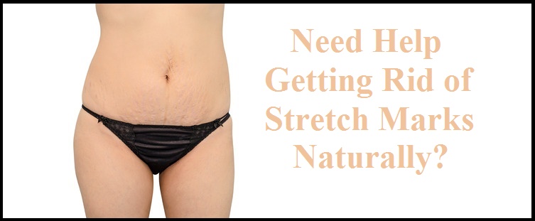 Help Getting Rid of Stretch Marks Naturally