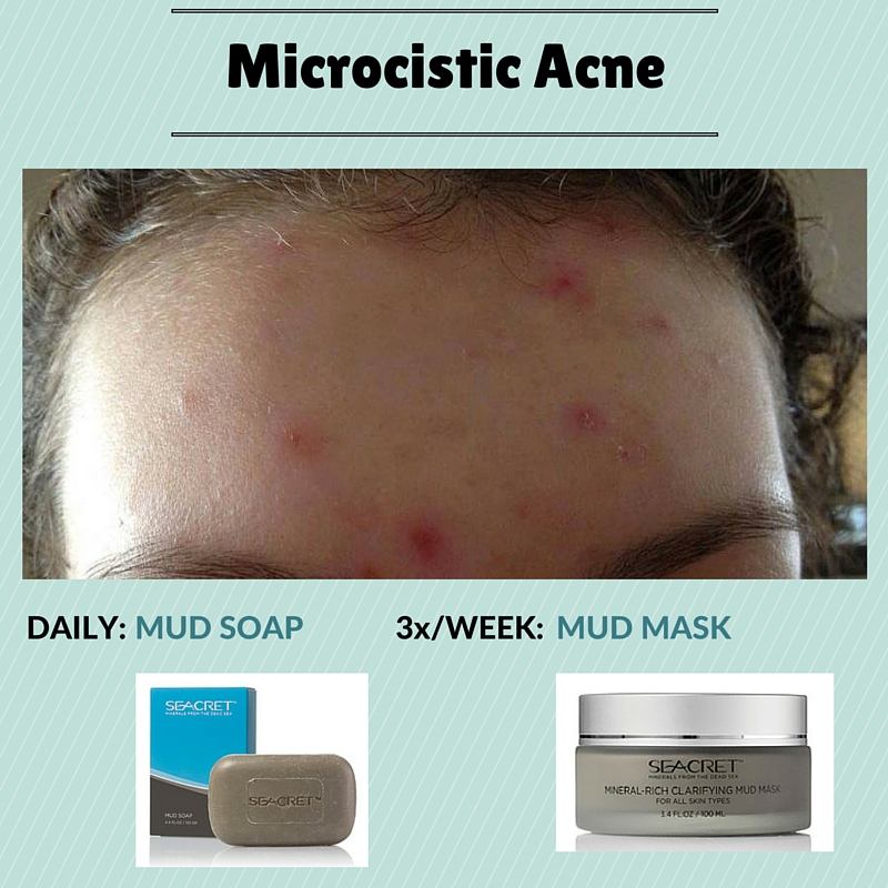 Back Acne Regimen