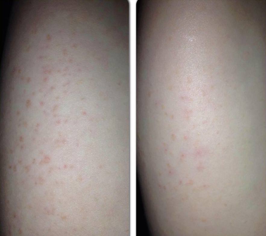 Irritating Rash