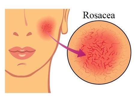 Rosacea on the Face