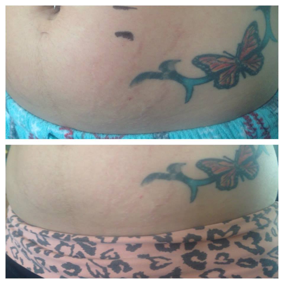 Help Getting Rid of Stretch Marks Naturally