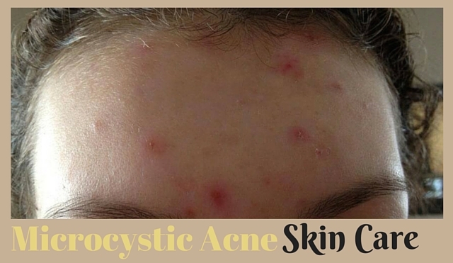 Microcystic Acne Skin Care