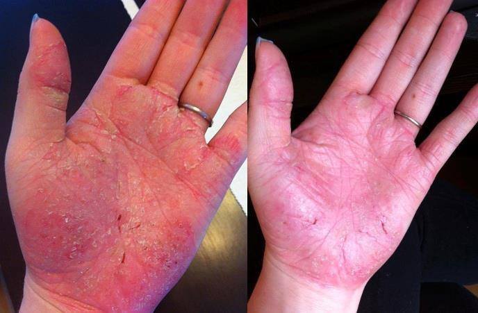 Psoriasis Regimen Results