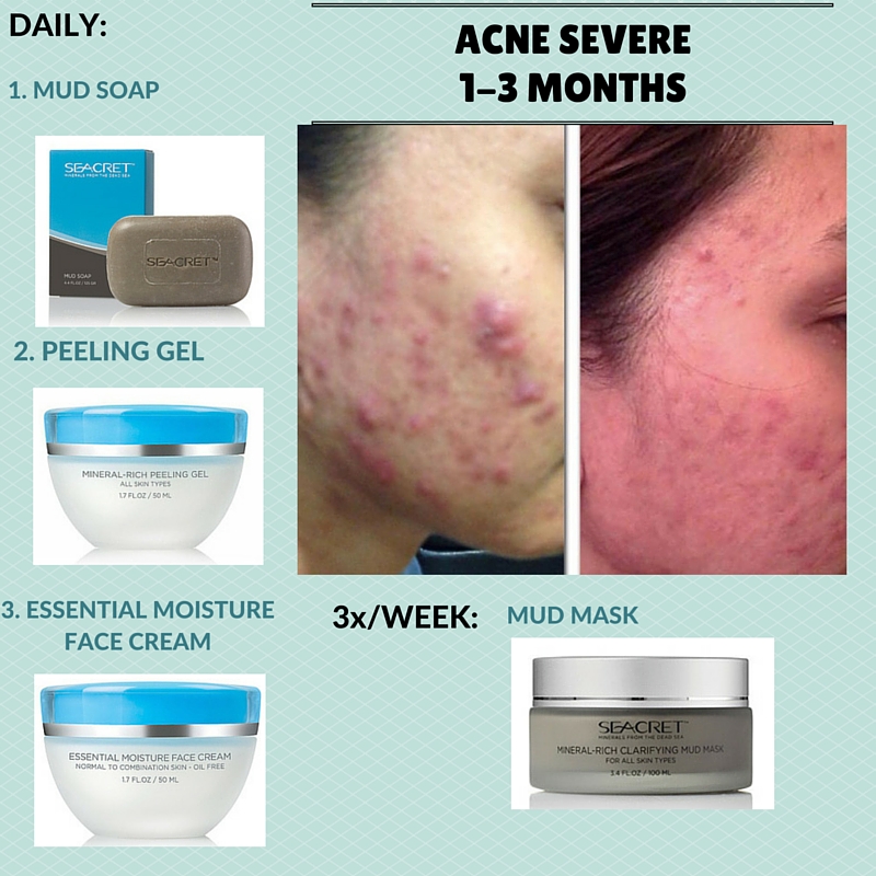 Severe Acne Regimen